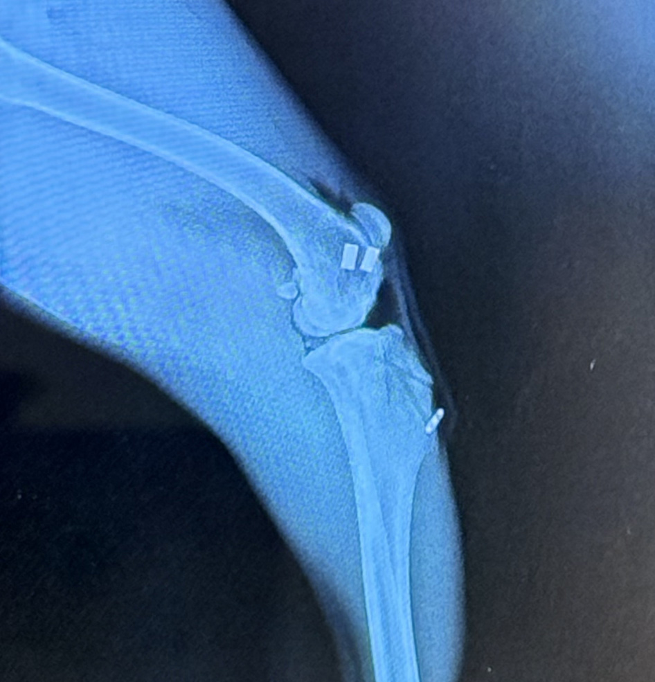Ruptured cruciate ligament surgery X-ray